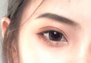 開內(nèi)外眼角怎么消腫快？開內(nèi)外眼角有什么壞處？