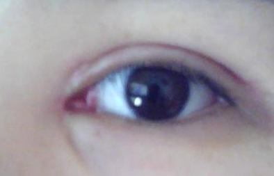 開內(nèi)外眼角效果怎么樣？開內(nèi)外眼角需要多長(zhǎng)時(shí)間？