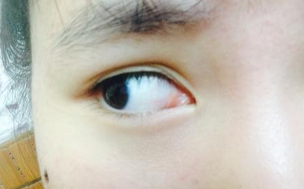 開內(nèi)眼角風(fēng)險有多大？