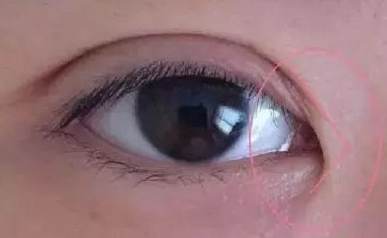 開內(nèi)眼角的作用有哪些？開內(nèi)眼角都會(huì)回縮嗎？
