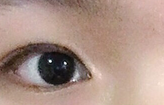 開內(nèi)眼角的危害有哪些？