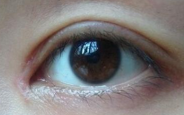 開內(nèi)眼角的禁忌癥是什么？