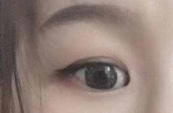 開內(nèi)眼角的手術(shù)費(fèi)用多少？術(shù)后禁忌癥有哪些？