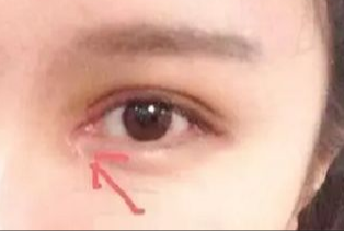 開眼角割雙眼皮拆線嗎？術(shù)后拆線疼嗎？