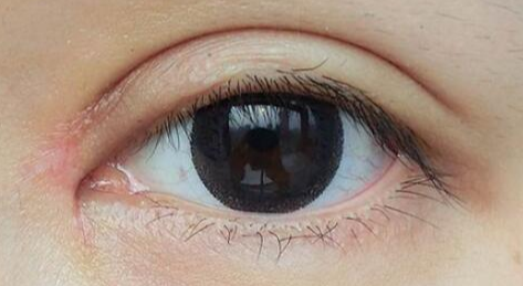 開眼角有哪些優(yōu)缺點？開眼角方法的過程有哪些？