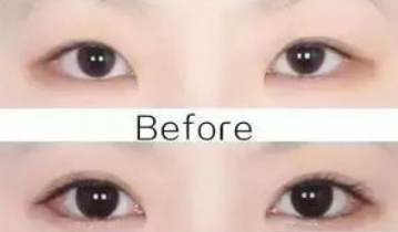 開眼角的危害大嗎？