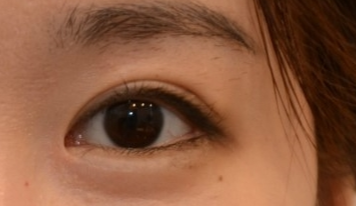 開(kāi)眼角有效果嗎？