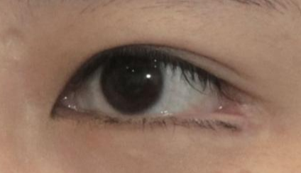 開眼角是永久的嗎？