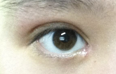 開眼角一定會(huì)出現(xiàn)疤痕嗎？
