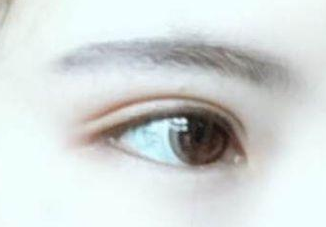 開眼角有幾種方法?開眼角有后遺癥嗎？