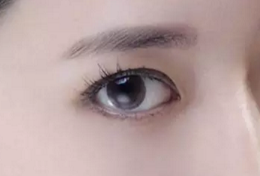 開眼角術(shù)后會不會反彈？