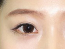 開眼角手術(shù)有哪些適應(yīng)人群呢？開眼角手術(shù)有哪些特點？