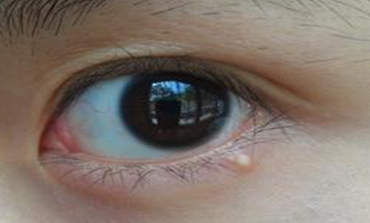 開外眼角手術(shù)會有后遺癥嗎？
