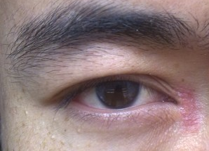 開眼角術(shù)后如何快速消腫？