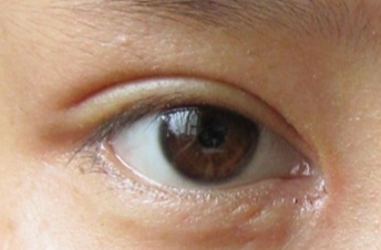 開(kāi)眼角手術(shù)會(huì)不會(huì)留疤？開(kāi)眼角手術(shù)后應(yīng)該注意什么？