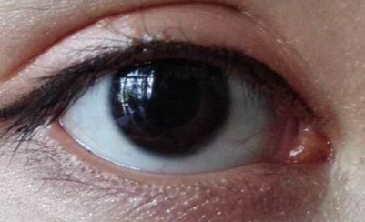 做開眼角疼不疼？做開眼角要多少錢？