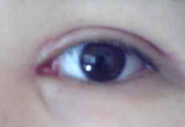 做完雙眼皮開內(nèi)眼角有風(fēng)險(xiǎn)嗎？做完開眼角怎樣護(hù)理？