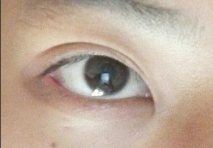 開眼角手術(shù)后會影響視力嗎？開眼角手術(shù)費(fèi)用貴嗎？