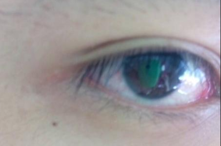 開眼角手術完全恢復需要多長時間？術后如何避免留疤？