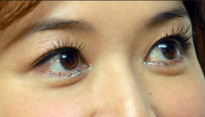 開眼角手術(shù)的優(yōu)點(diǎn)有哪些？