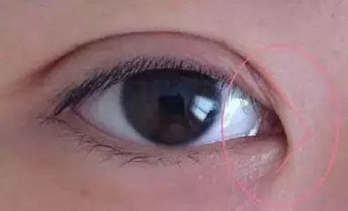 開眼角手術(shù)價格要多少錢？