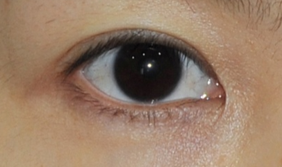 做完開眼角怎樣護(hù)理？