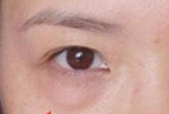 光纖溶脂去眼袋手術(shù)有哪些優(yōu)勢？