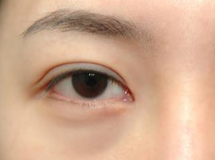 光纖溶脂去眼袋要多久消腫？術(shù)后如何護(hù)理？