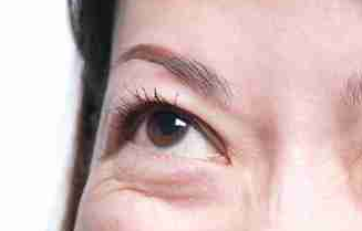 光纖溶脂祛眼袋好不好？