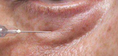 眼袋脂肪釋放的優(yōu)點(diǎn)有哪些？