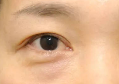 什么是埋線去眼袋？