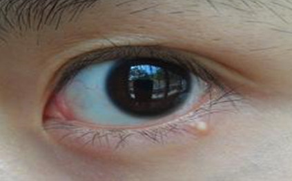 不開刀去眼袋安全嗎？不開刀去眼袋多少錢？