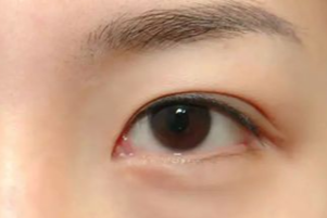 光纖溶脂祛眼袋有效果嗎？