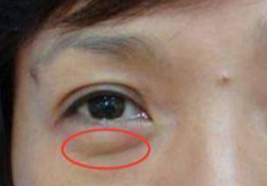 埋線去眼袋能維持多久？