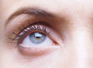 埋線(xiàn)去眼袋什么時(shí)候做好？埋線(xiàn)去眼袋有效嗎？