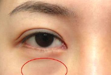 光纖溶脂祛眼袋怎么樣？