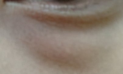 激光去眼袋和內(nèi)切哪個好？