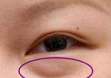 激光去眼袋有什么好處？激光祛眼袋有用嗎？