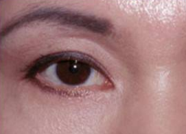 激光可以祛眼袋嗎？