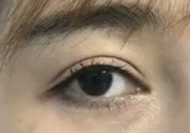 激光祛眼袋痛不痛？激光祛眼袋手術(shù)怎么樣？