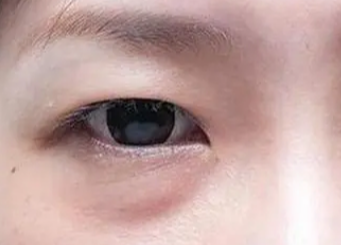 激光祛眼袋有用嗎？