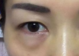 激光可以祛眼袋嗎？激光祛眼袋有哪些副作用？