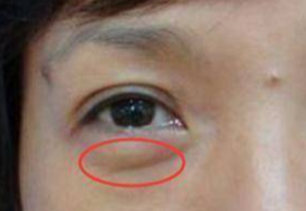 激光祛眼袋要多少錢？