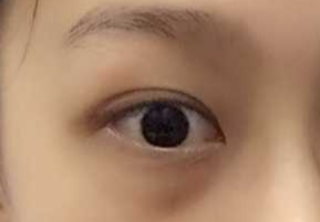 激光祛眼袋要多少錢？