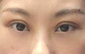 激光祛除眼袋的手術(shù)效果好嗎？