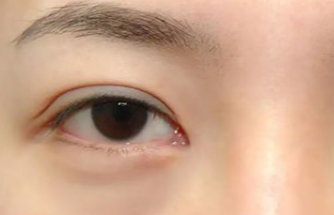 激光去眼袋多久做一次？