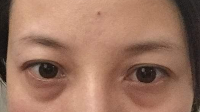 激光祛除眼袋有效嗎？