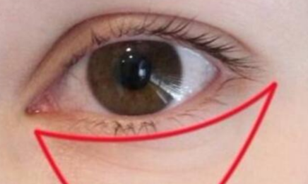 激光祛眼袋有什么利弊？