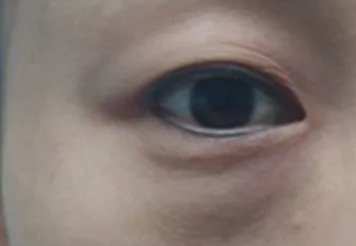 激光去眼袋可以管多久？