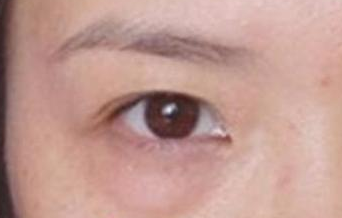 激光去除眼袋后遺癥有哪些？